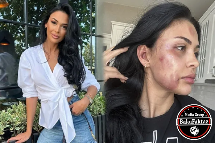 Bakıda model sevgilisi tərəfindən döyülüb?- RƏSMİ AÇIQLAMA